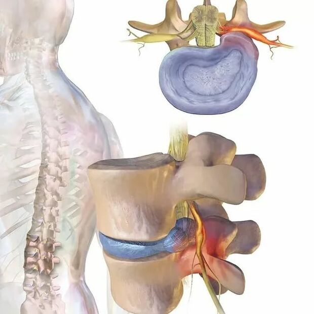 intervertebraalsete ketaste probleemid