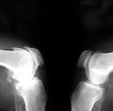 Osteoartroos on x-ray