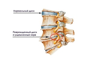 Sümptomid emakakaela osteohondroosi