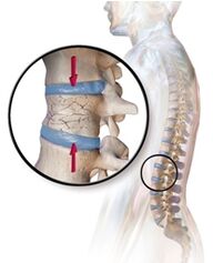 Osteoporoos kutsub esile nimmepiirkonna seljavalu